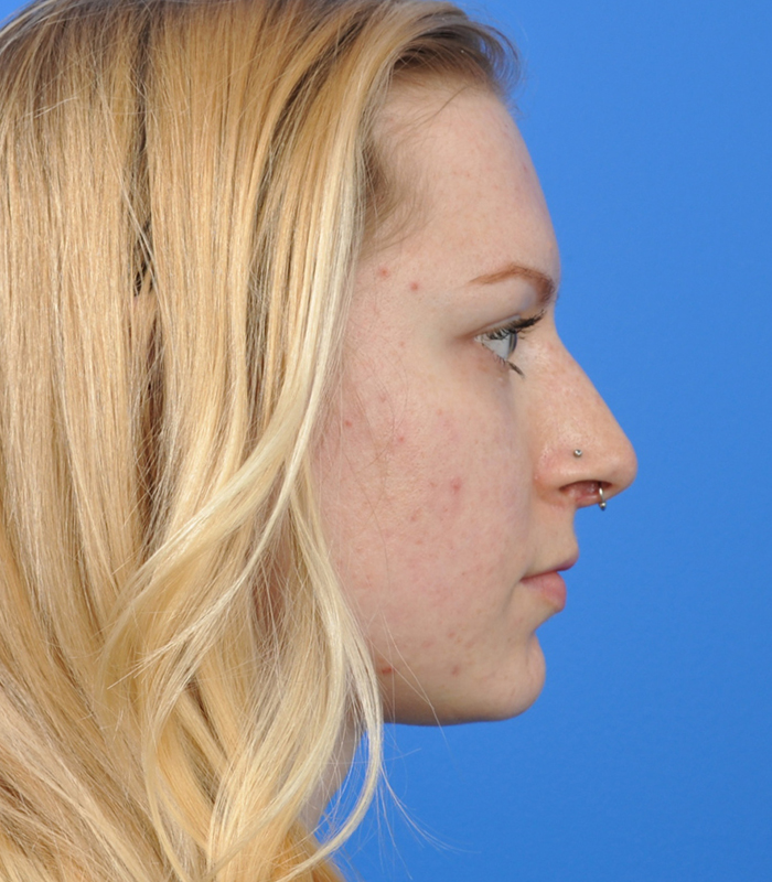 Rhinoplasty