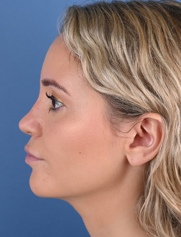 Revision Rhinoplasty