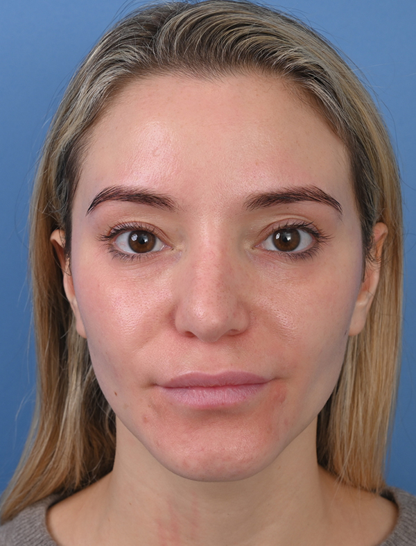 Revision Rhinoplasty