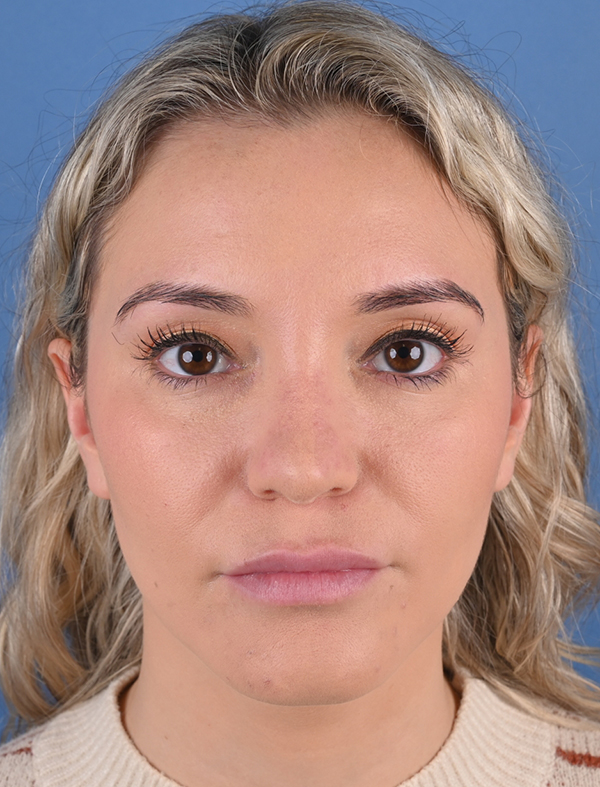 Revision Rhinoplasty