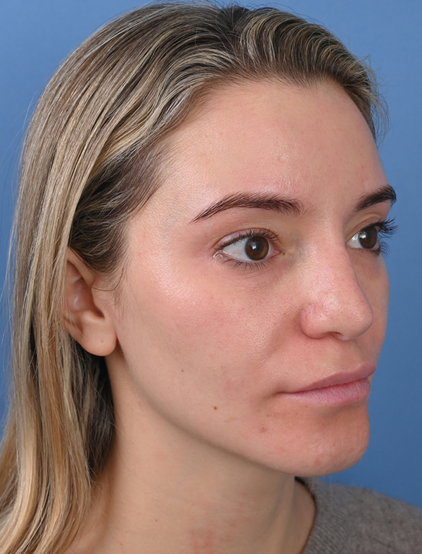 Revision Rhinoplasty