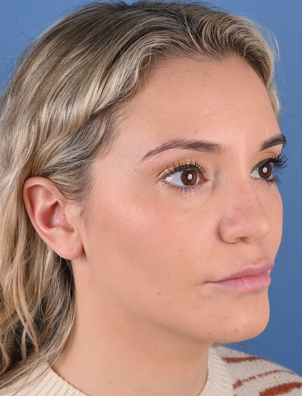 Revision Rhinoplasty