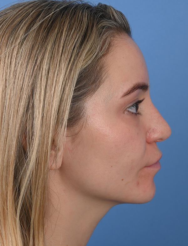 Revision Rhinoplasty