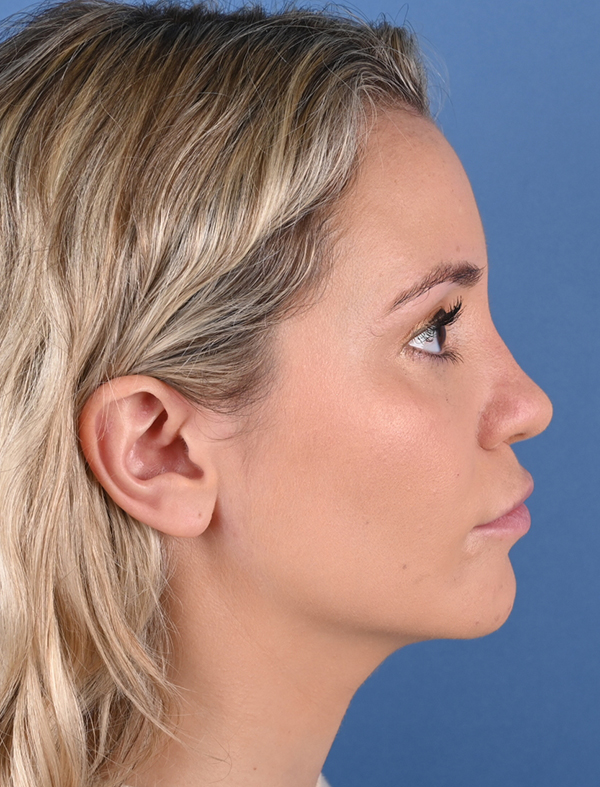 Revision Rhinoplasty