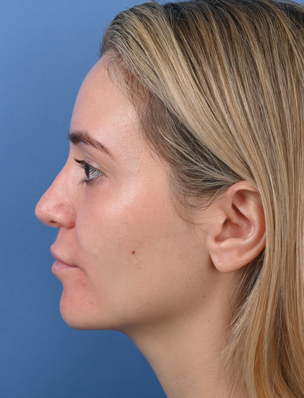 Revision Rhinoplasty