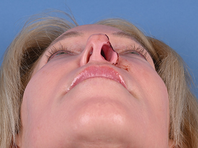 Nasal Reconstruction