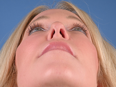 Nasal Reconstruction