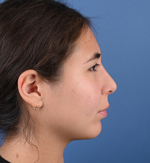 Rhinoplasty