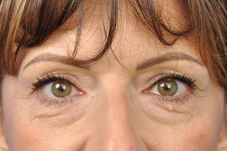 Blepharoplasty