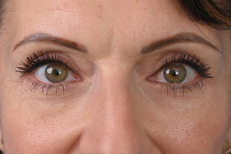 Blepharoplasty