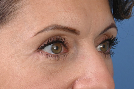 Blepharoplasty