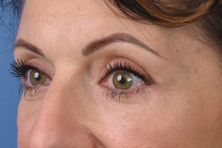 Blepharoplasty