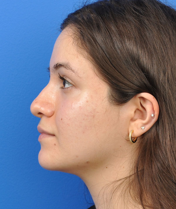 Rhinoplasty