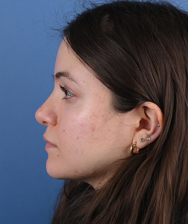 Rhinoplasty