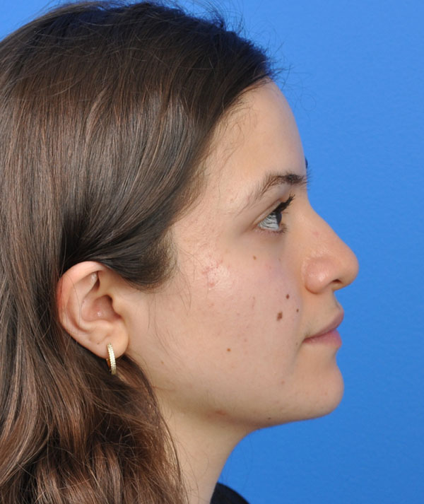 Rhinoplasty