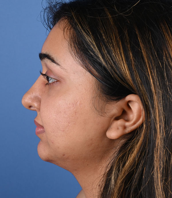 Rhinoplasty