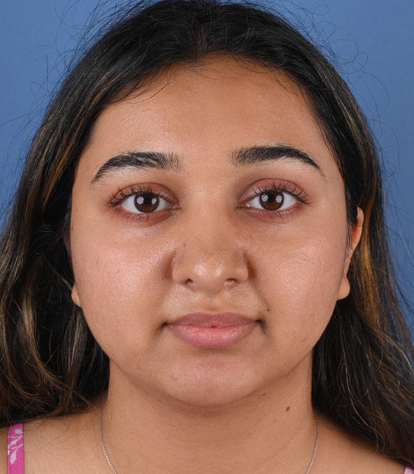 Rhinoplasty