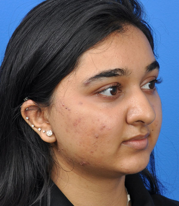 Rhinoplasty