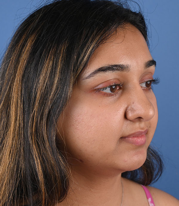 Rhinoplasty