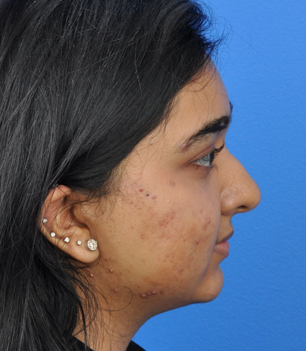 Rhinoplasty