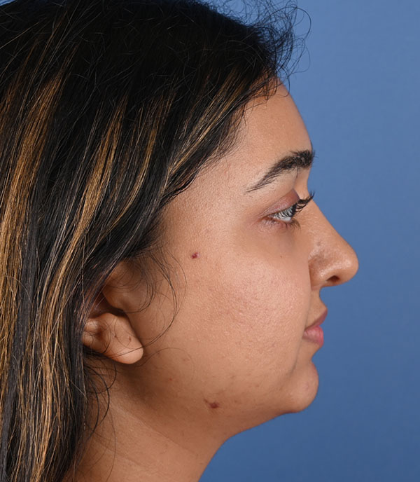 Rhinoplasty