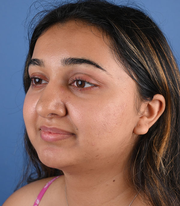 Rhinoplasty
