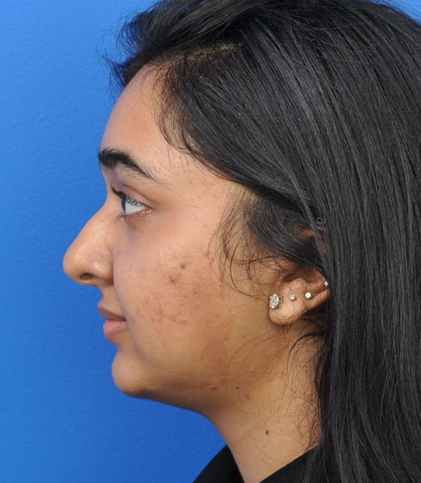 Rhinoplasty