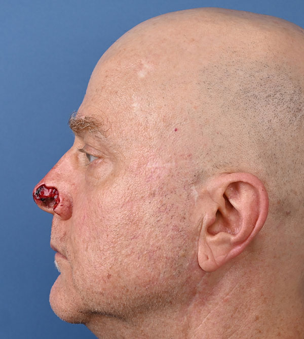 Nasal Reconstruction