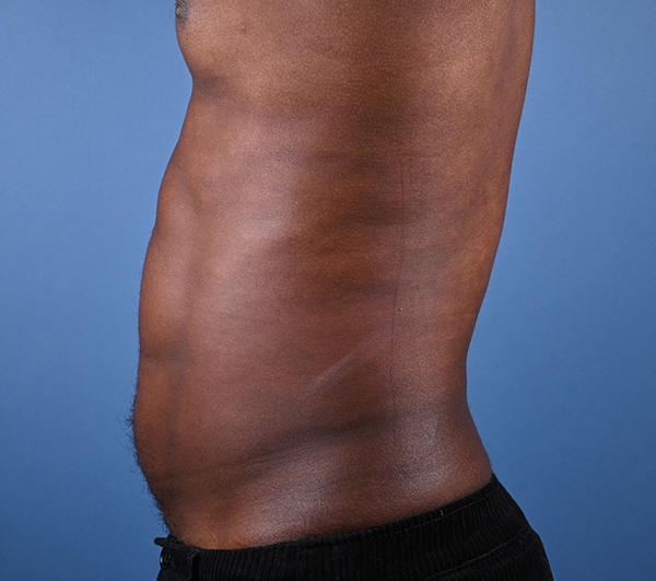 Male Abdominal Etching