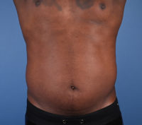 Male Abdominal Etching