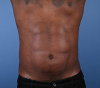 Male Abdominal Etching