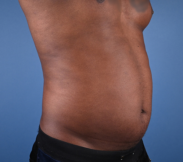 Male Abdominal Etching