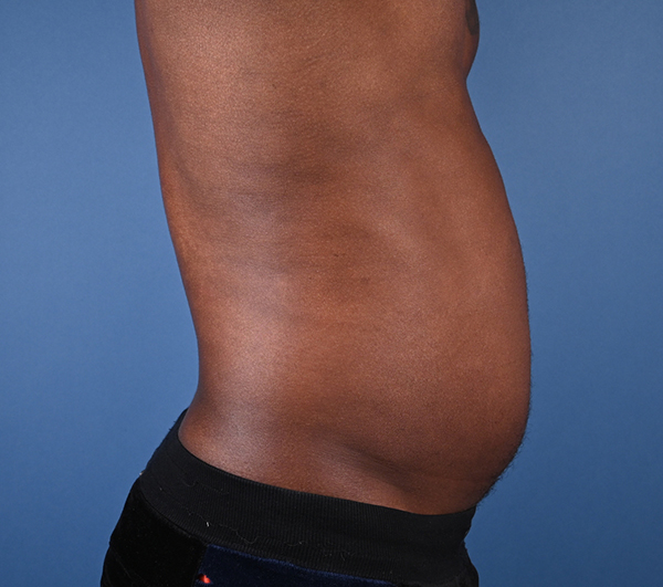 Male Abdominal Etching