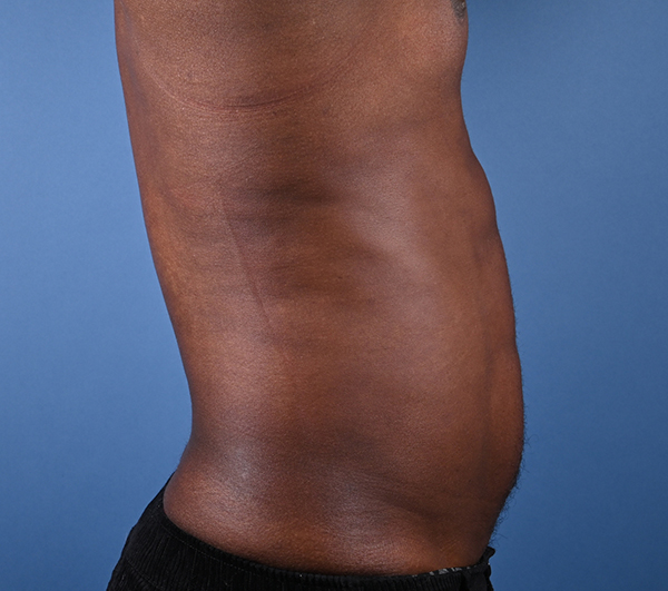 Male Abdominal Etching