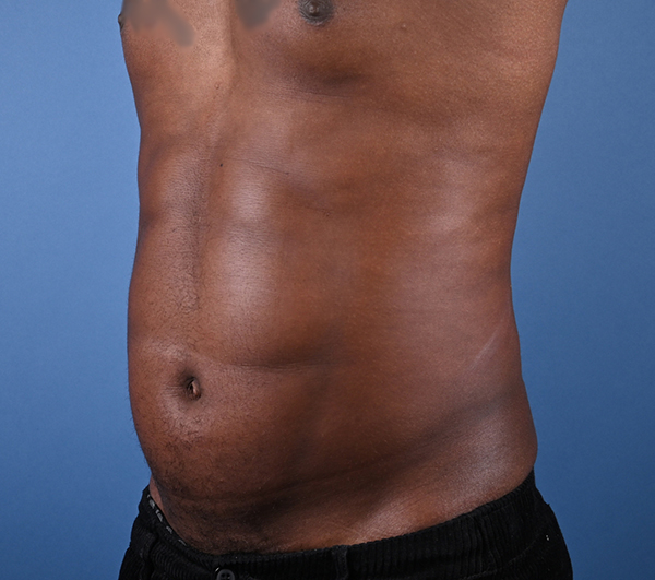 Male Abdominal Etching