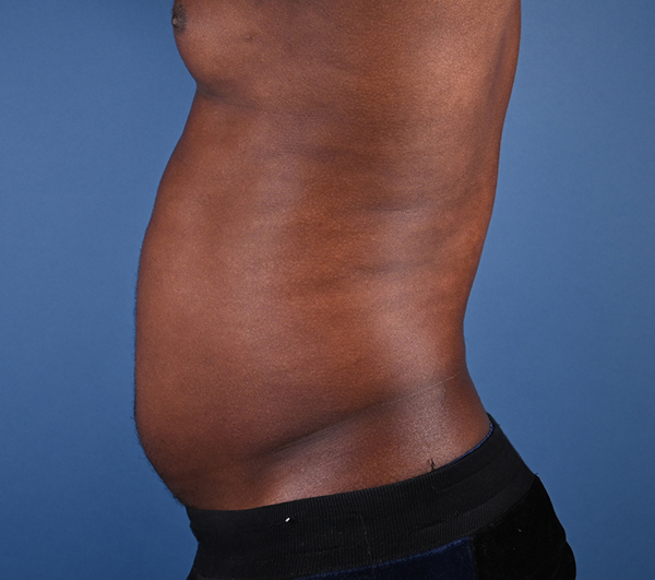 Male Abdominal Etching