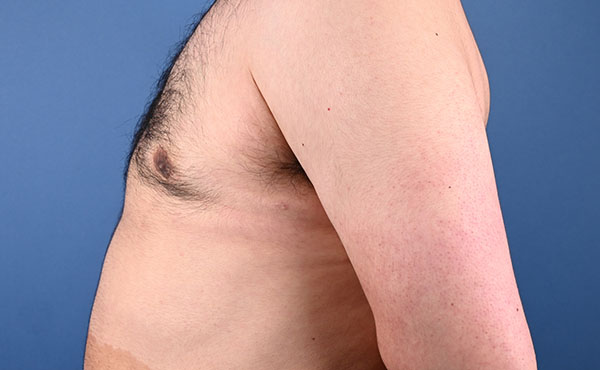 Gynecomastia