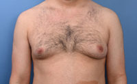 Gynecomastia