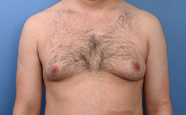 Male Gynecomastia Before and After