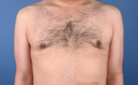 Gynecomastia