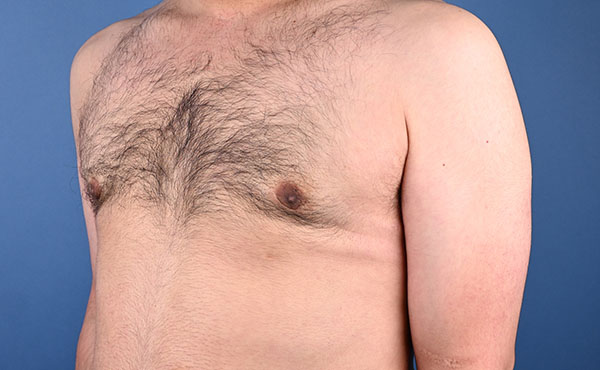 Gynecomastia