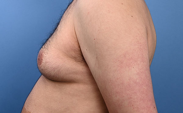 Gynecomastia