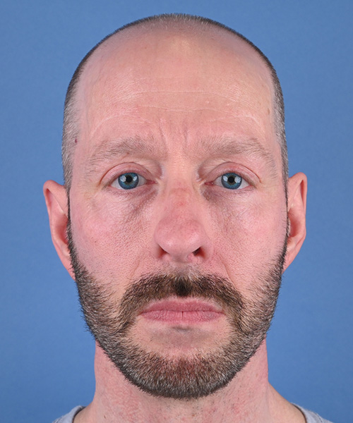 Male Facelift