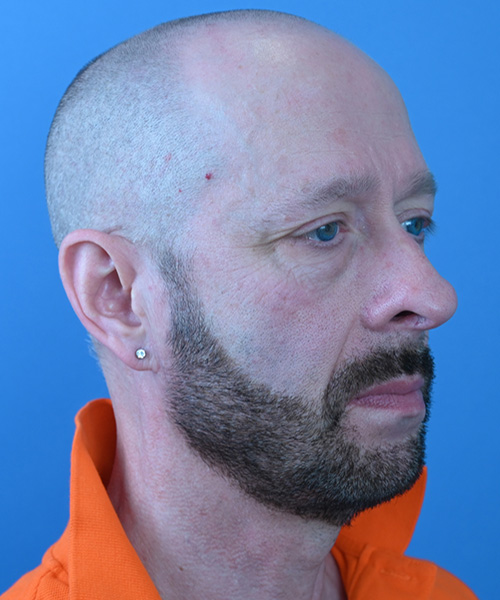 Male Facelift