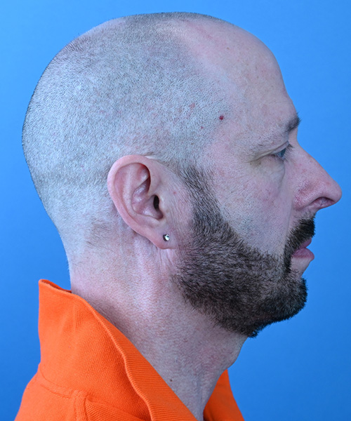 Male Facelift