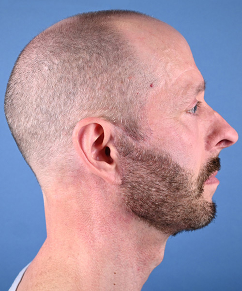 Male Facelift