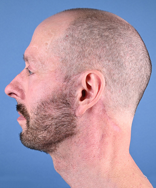 Male Facelift