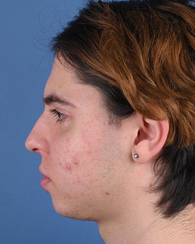 Male Genioplasty