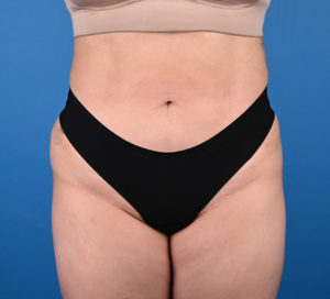 Liposuction