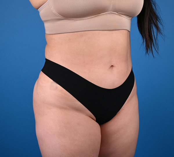 Liposuction